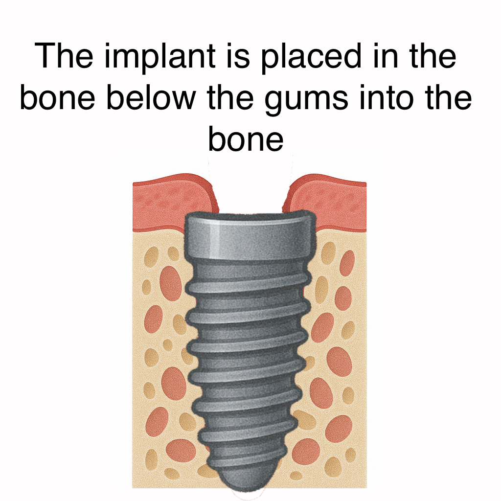 implantnext